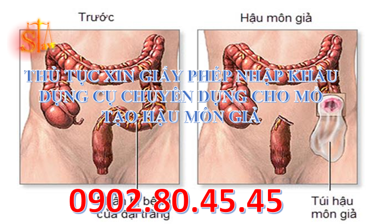 THỦ TỤC XIN GIẤY PHÉP NHẬP KHẨU  DỤNG CỤ CHUYÊN DỤNG CHO MỔ TẠO HẬU MÔN GIẢ